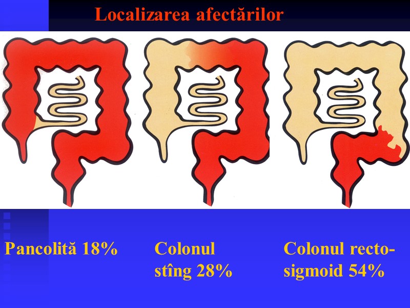 Localizarea afectărilor Pancolită 18%  Colonul  stîng 28%  Colonul recto- sigmoid 54%